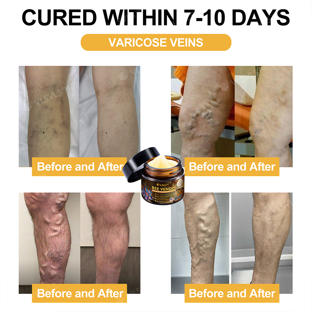 Official Store: ๐ฆตVLSVLSโข Bee Venom Arthritis Therapy Cream(Specially for older adults & AAOS recommends)๐ฅ๐ณ๐๐๐ ๐
๐๐ ๐๐๐๐๐๐๐๐๐ 7๐% ๐๐๐